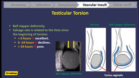 gold standard test for testicular torsion|ultrasound testicular torsion test.